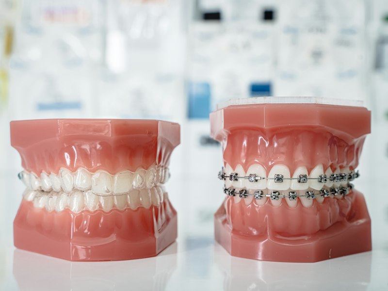 Modelo dentario con brackets, imagen de referencia del tratamiento de ortodoncia.